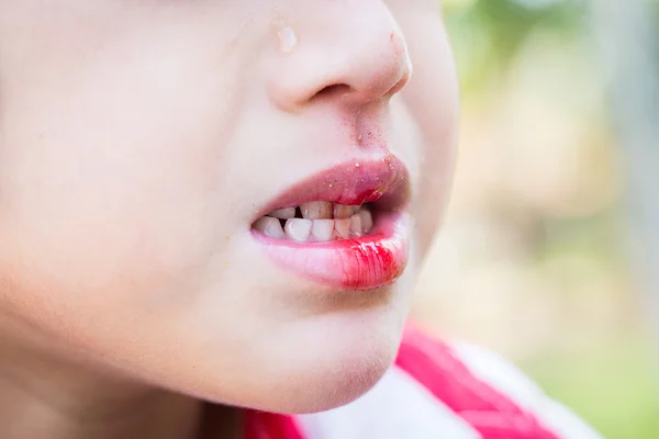 Little boy Bleeding at the mouth — Stock Image Little boy Bleeding at the mouth Stock Photo
