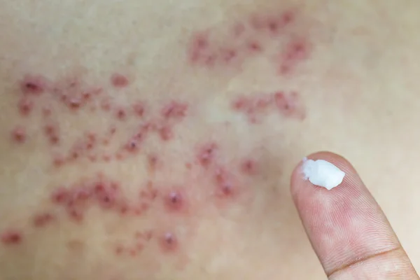 Kırmızı diken diken ve deride kabarcıklar kaldırdı