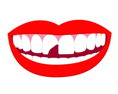 Kırık diş çizimi. Daha önce dişleri çatlamış bir şekilde gülümsüyordu. Vektör beyaz arkaplanda izole edildi. Posterler ve afişler için iyi. bilgi grafiği.