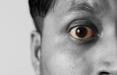 Hintli bir erkeğin sarı gözünü kapat, sağlık hizmeti kavramı.