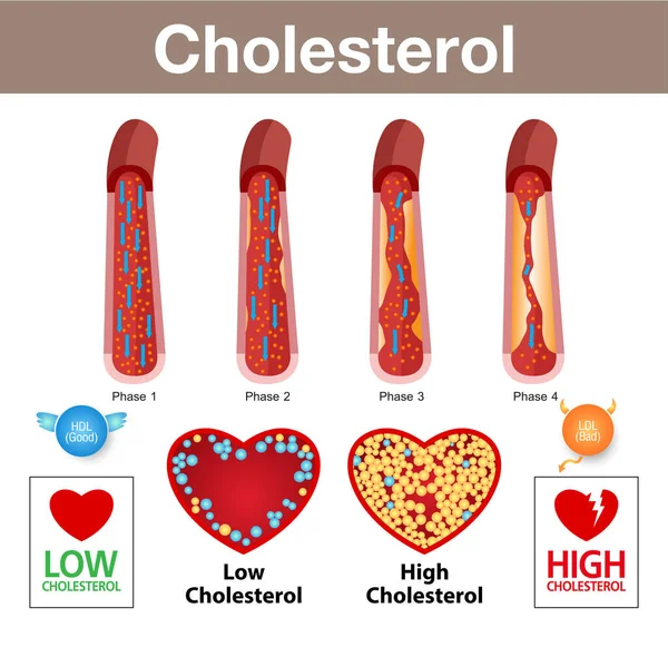 Cholesterol Slagader Gezondheidsrisico Vectorontwerp — Stockvector