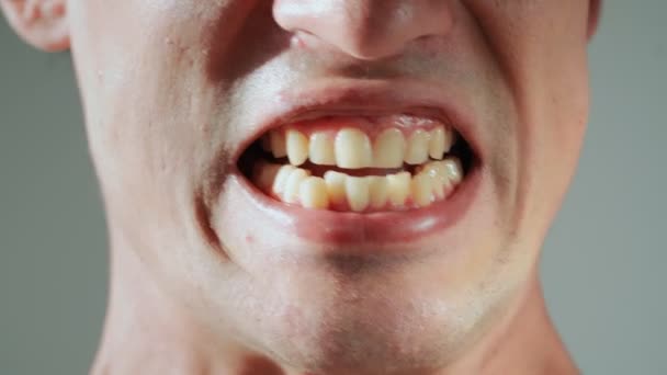 Man Shows His Yellow Crooked Protruding Teeth Malocclusion Close — Stock Video