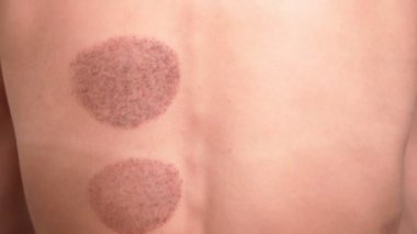 Yaralı omzunda Kinesio bandı olan atletik bir kadın kupa terapisi prosedüründen sonra sırtını geriyor. Spor yaralarının tedavisi. Sırt ağrısı. Beyaz arkaplanda izole