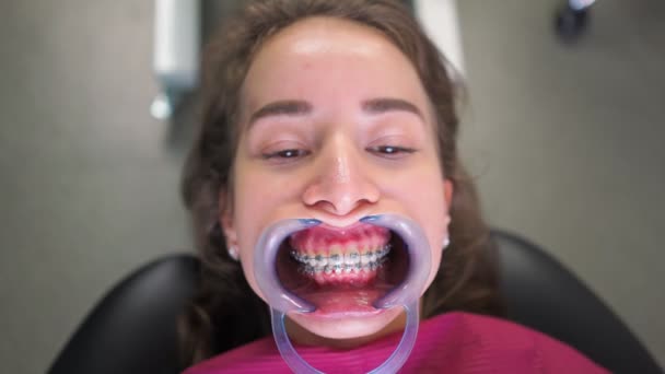 Young Woman Patient Retractor Mouth Braces Dental Office Lies Hospital — Stock Video