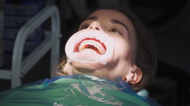 Young Woman Patient Retractor Mouth Braces Dental Office Lies Hospital — Stock Video