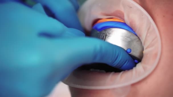 Stomatologul are dinti de impresie pentru instalarea fatetelor pacientului in clinica stomatologica — Videoclip de stoc