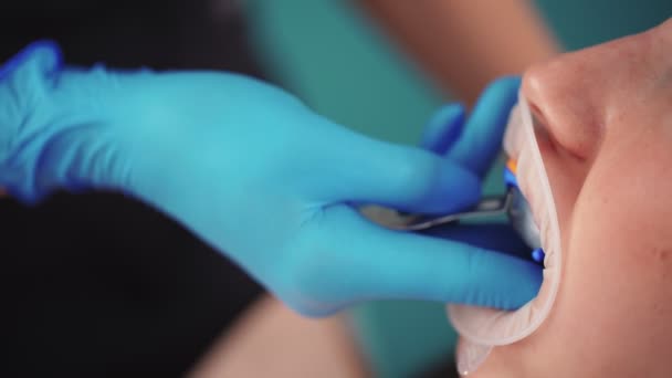 Gros plan dentiste plaçant un protège-dents spécial dans la bouche de la femme à la clinique dentaire — Video