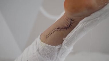 Achilles tendonundaki ameliyattan sonra, bacağında diş teli olan dikişe yakın çekim.