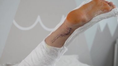 Achilles tendonunu dikmek için ameliyattan sonra bacağa yakın çekim.