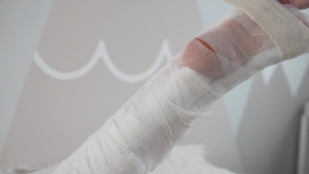Κοντινό πλάνο του γύψου langette ντύσιμο μετά από χειρουργική επέμβαση για να ράψετε τον Αχιλλέα τένοντα — Αρχείο Βίντεο