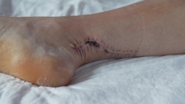 Hastaların ayak bileklerine yakın çekim. 