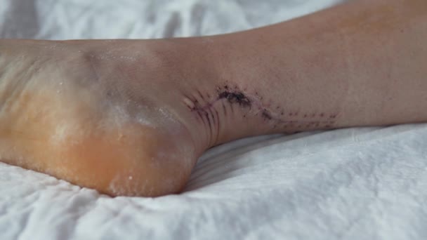 Κοντινό πλάνο της ραφής σε ένα γυναικείο αστράγαλο μετά από χειρουργική επέμβαση για να ράψει μέχρι τον Αχιλλέα τένοντα — Αρχείο Βίντεο