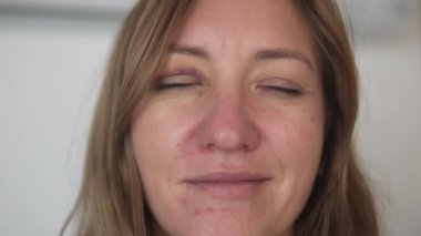 Yüzünde tahriş ve göz çevresinde çürük olan bir kadının yakın plan portresi. Gerçek deri dokusunu, sağlık durumunu, iyileşme sürecini ve insanı gösteren doğal, rötuşlanmamış bir görünüm.