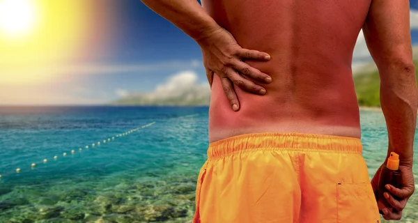 Man with sunburned skin — Stock Photo, Image