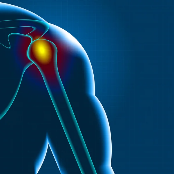 Schouderpijn — Stockvector