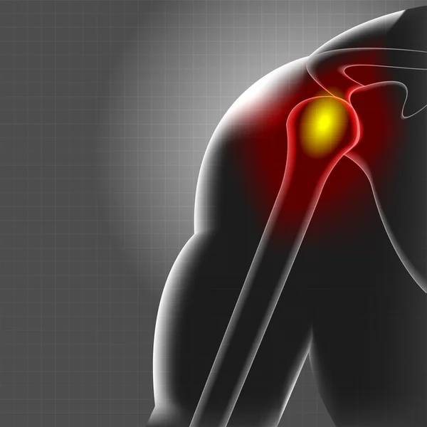 어깨 통증 — 스톡 벡터