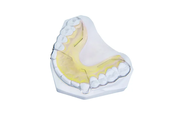 Retainer and brace with white fake gum — Stock Photo, Image