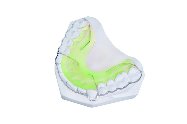 Retainer and brace with white fake gum — Stock Photo, Image