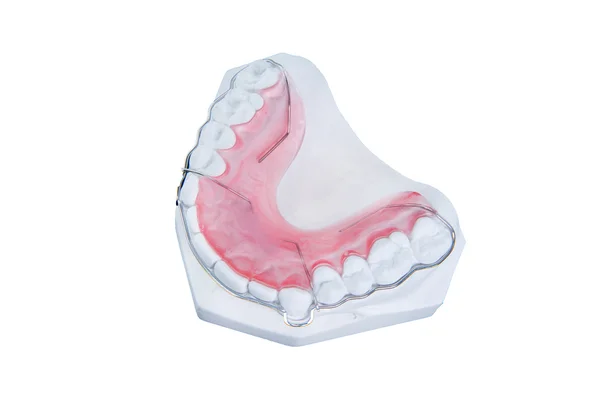 Retainer and brace with white fake gum — Stock Photo, Image