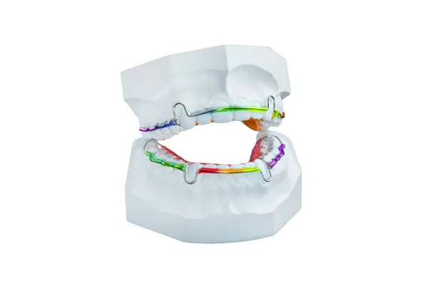 Dental brace with plaster cast — Stock Photo, Image