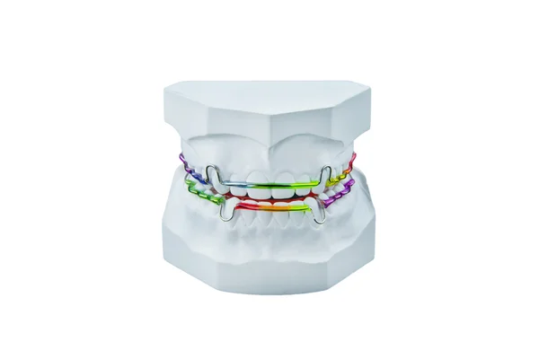 Dental brace with plaster cast — Stock Photo, Image