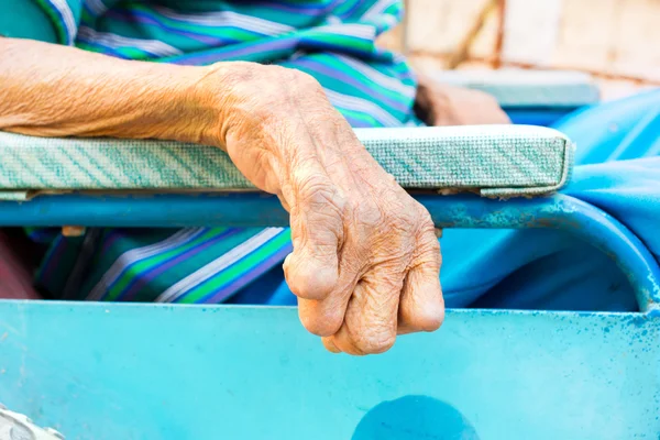 Closeup hand of old man suffering from leprosy, amputated hand, — Stock Photo, Image