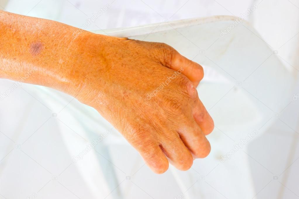 closeup hand of old man suffering from leprosy on the backrest o
