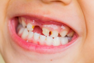 seçici odak Asyalı küçük kız diş kırık