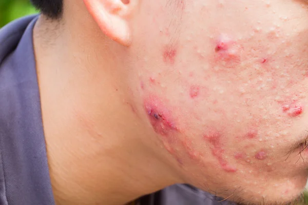 De horizontale foto close-up van mannelijke Wang met grote puistje of acne een — Stockfoto