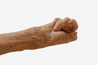 right hand of a leprosy isolated on white background clipart