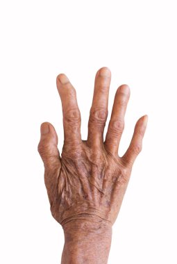 right hand of a leprosy isolated on white background clipart