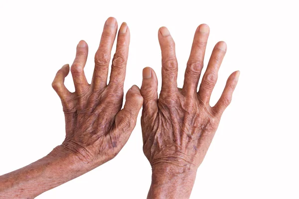 Hands of a leprosy isolated on white background — Stock Photo, Image