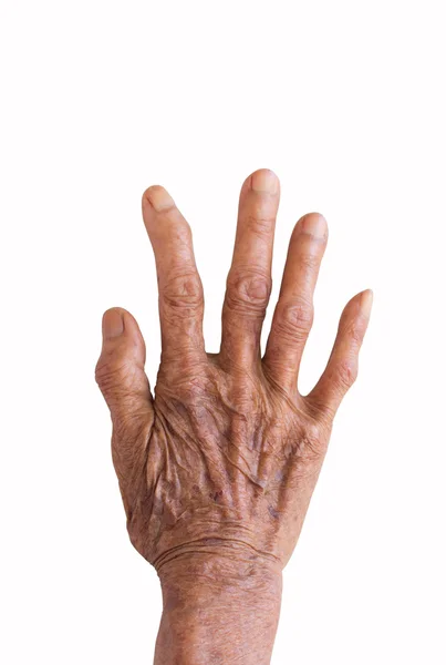 Right hand of a leprosy isolated on white background — Stock Photo, Image