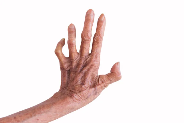 Mão esquerda de uma lepra isolada sobre fundo branco — Fotografia de Stock