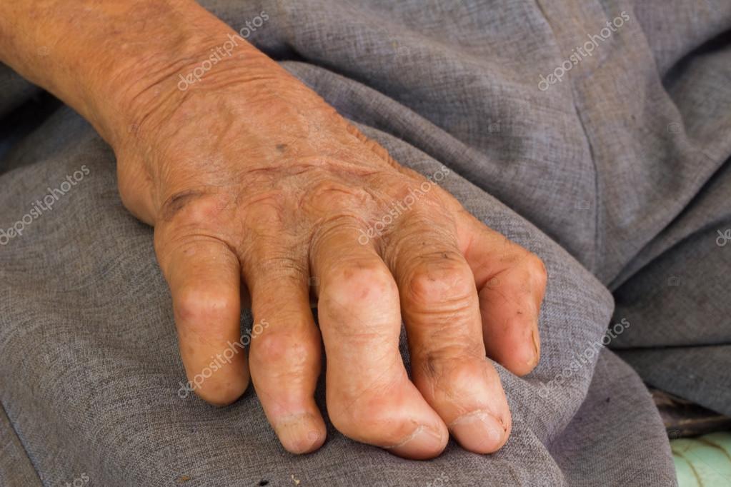 leprosy #hashtag
