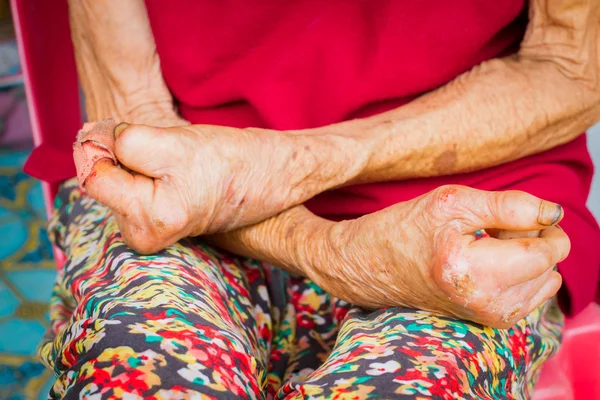Closeup ruce staré ženy trpící malomocenstvím, amputované han — Stock fotografie