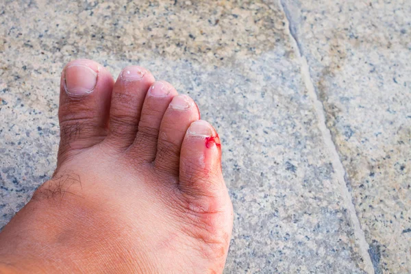 Herida sangrienta en el pie de un hombre — Foto de Stock