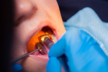 Diş hekimi tedavi hastaların diş dişçi içinde.