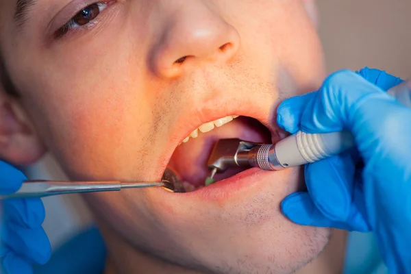 Zahnarzt Behandlung eines Patienten Zähne beim Zahnarzt. — Stockfoto