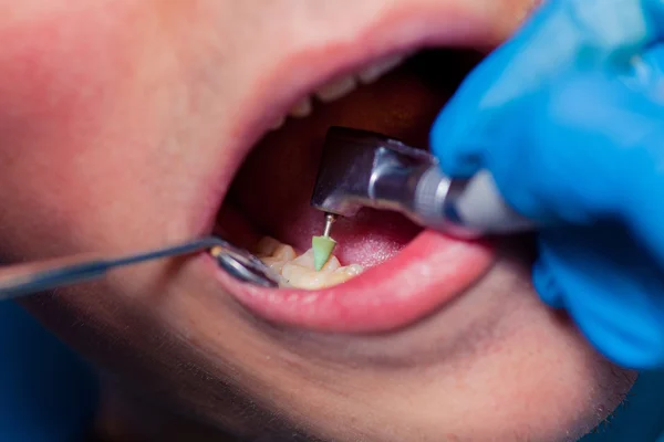 Лікування зубів у стоматолога . — стокове фото
