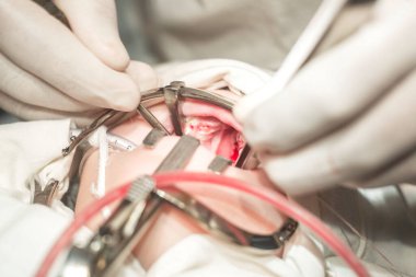 Diş hekiminin elleri, yakın plan. Yarık damağındaki kusuru ortadan kaldırmak için yapılan operasyon, sert damak patolojisi. Çocuğun ağzı muhafazakârın ağzıyla açık, kanlı bir yara, açık. Diş hekimliği. Maksimum yüz ameliyatı. Pediyatrik 