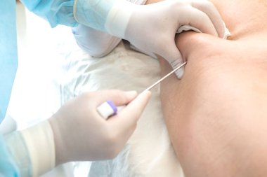 Uzun iğne kullanan bir onkolog, çocuklarda lösemi, Ewing sarkomu ve kemik iltihabı hastalığı teşhisi koymak için ileumu delmiş. Kemik kanseri teşhisi Pediatrik onkoloji