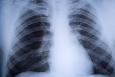 x-ray of the lungs of a teenager. Lung pathology. front x-ray of a child's chest clipart