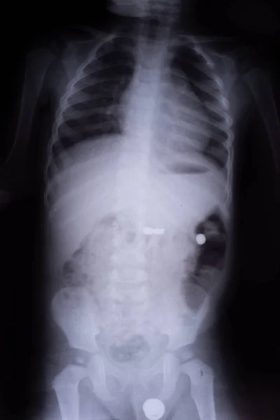 Radiografia Bambino Con Una Batteria Estranea Nel Tratto Gastrointestinale Pellicola — Foto Stock