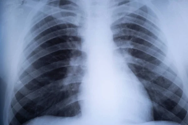 Röntgen Lungorna Tonåring Lungpatologi Främre Röntgen Ett Barns Bröst — Stockfoto