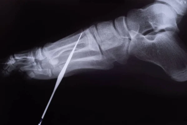儿童X光X光影像中的异物脚X光 指甲穿刺 工业伤害的概念形象 — 图库照片