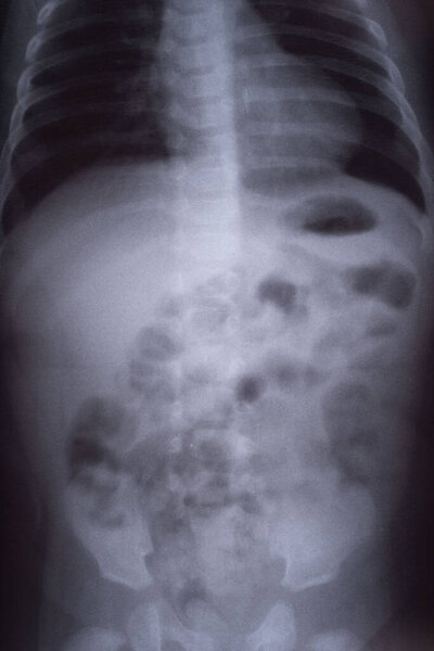 intestinal obstruction in a child x ray.