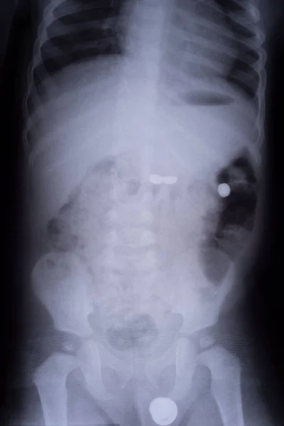 Рентген Дитини Чужорідною Батареєю Шлунково Кишковому Тракті Рентгенівська Плівка Монети — стокове фото