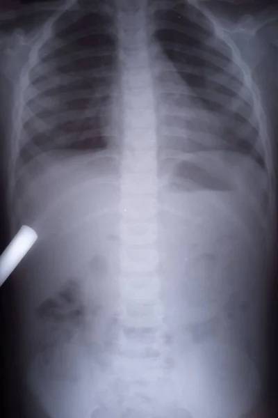 Röntgenkép Gázról Egy Gyereknél Differenciáldiagnózis Intussusceptio Egy Gyermek Röntgen Humen — Stock Fotó