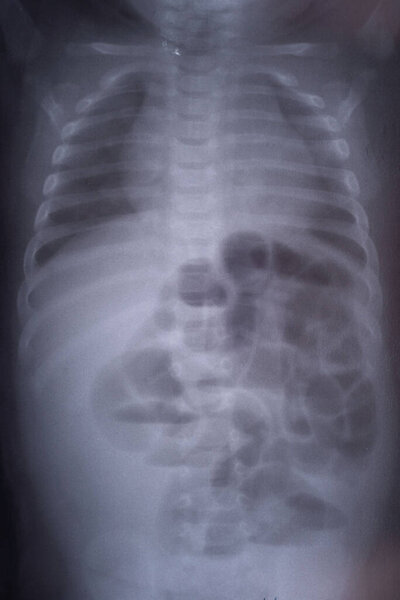 intestinal obstruction in a child x ray.
